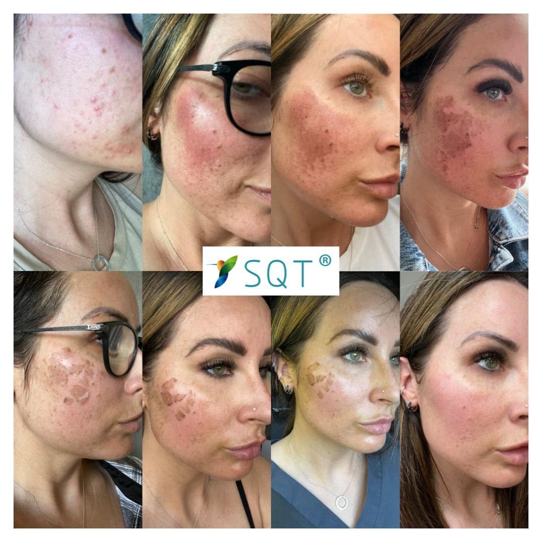 SQT Treatment