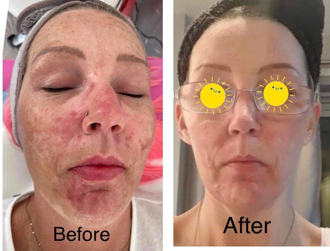 Skin After Treatment